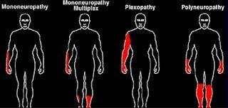 mononeuropathy
