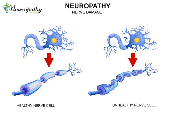 healthy and unhealthy nerve cell